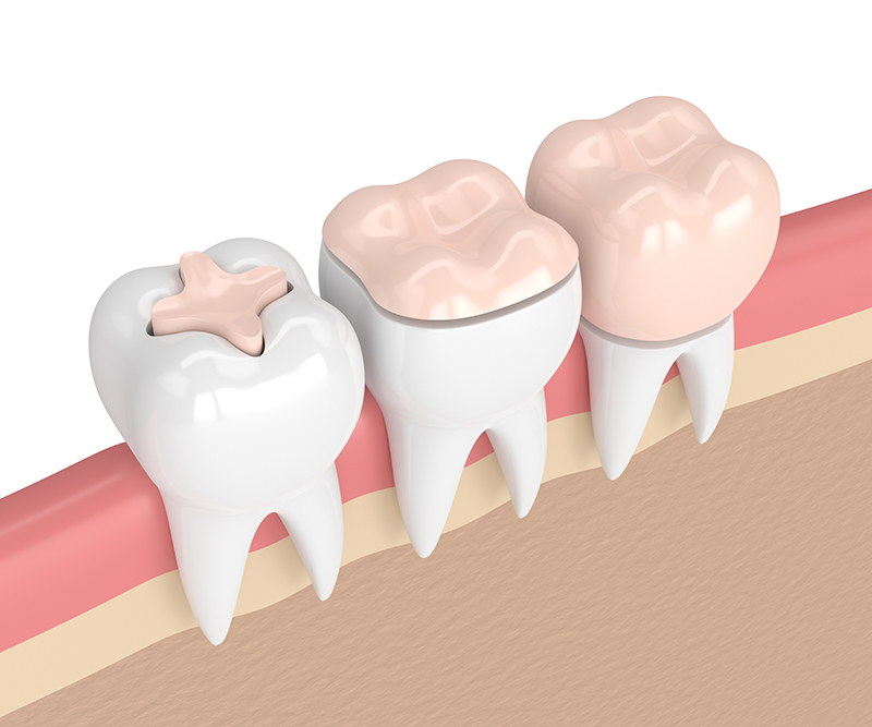 The image shows a set of three dental implants with crowns, each representing a different stage of the dental implant process  an uncovered implant, a covered implant with a temporary crown, and a final implant with a permanent crown.
