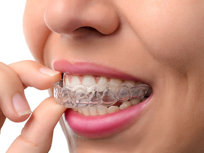 A person holding a clear dental aligner to their teeth.