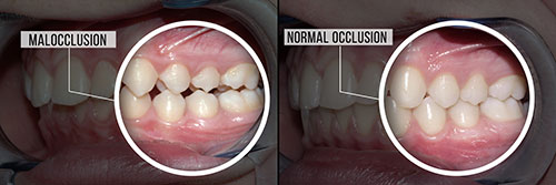 An image depicting a medical procedure with a magnified view of teeth and gums, labeled  Malocclusion  and  Normal occlusion .