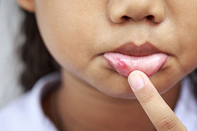 A young child with a pimple, holding their finger to it.