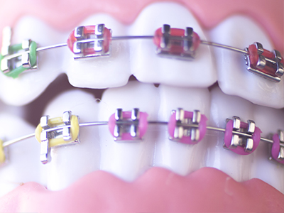 The image shows a close-up of a person s teeth with colorful braces, featuring pink, yellow, and red elastic bands.